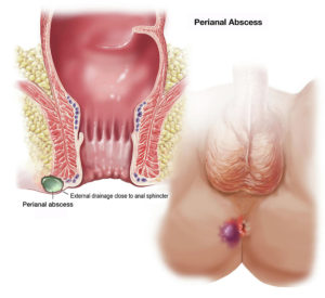 Gejala Fistula ani