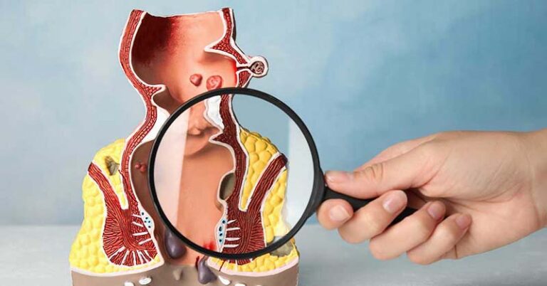 abses perianal